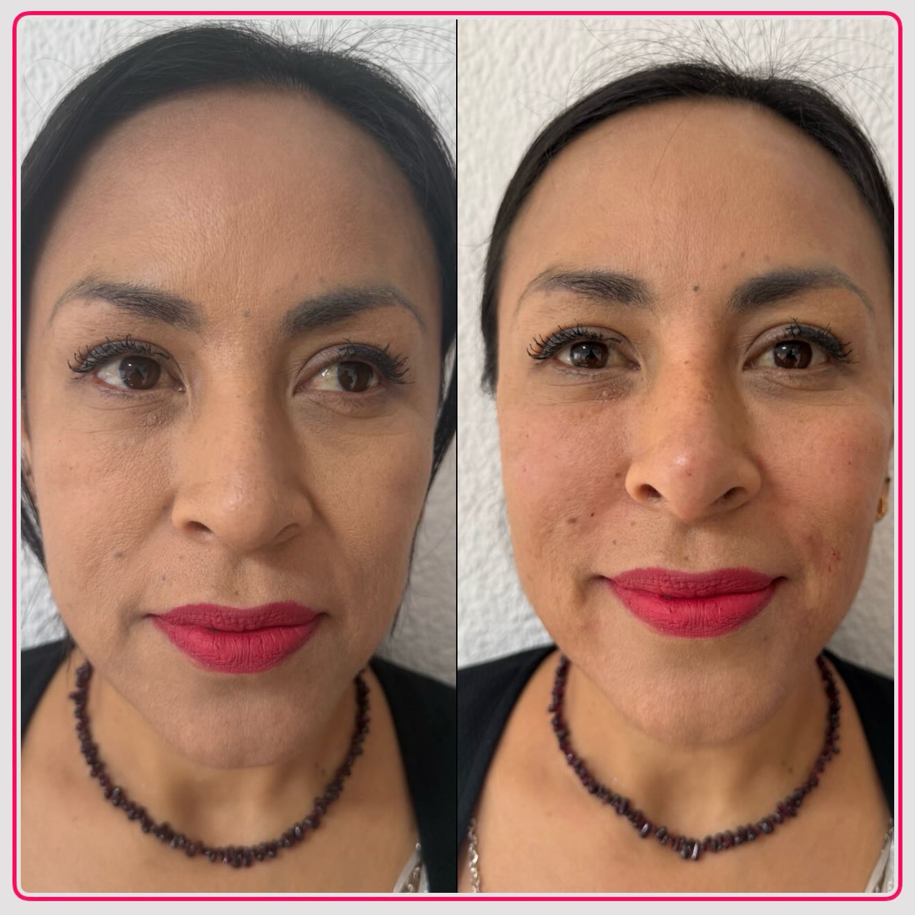 Armonización Facial Completa