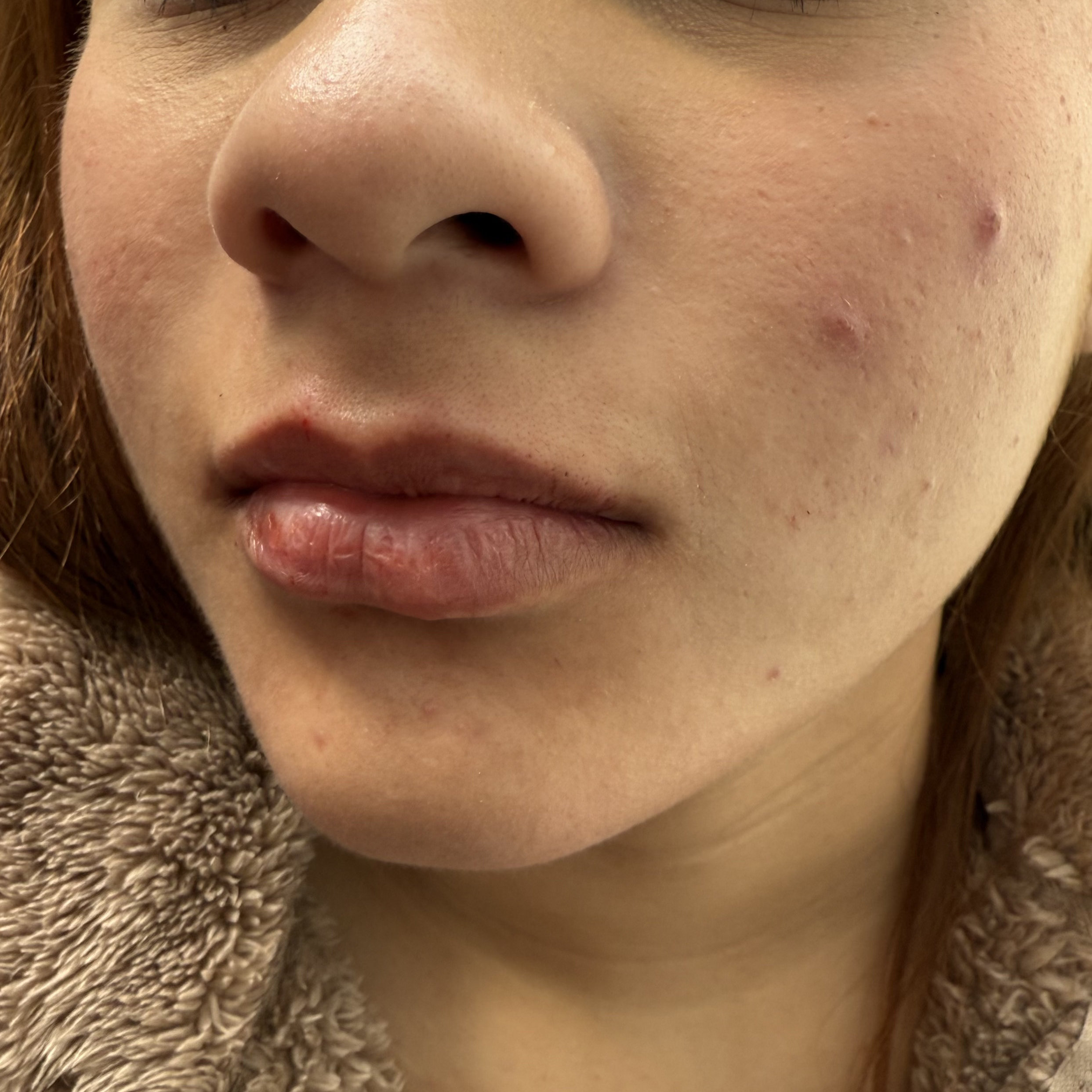 Aumento y Perfilado de Labios