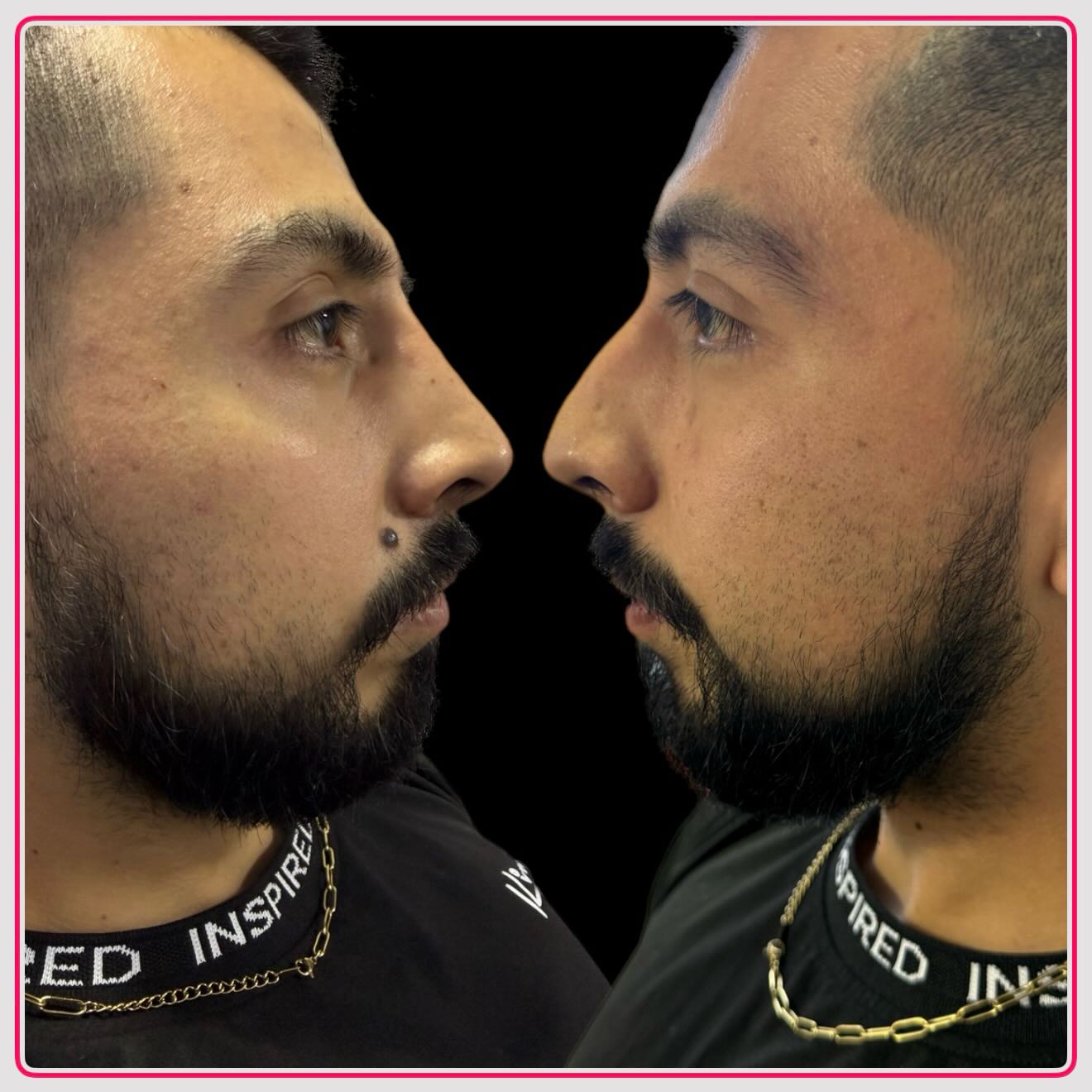 Rinomodelación con Ácido Hialurónico